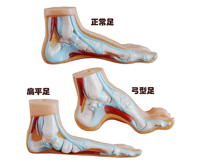 正常足、扁平足、弓型足模型